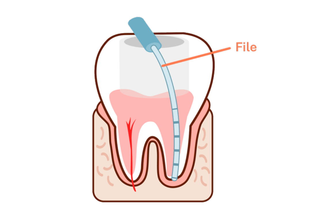 Endodontist for Root Canal Treatment Singapore AtriaCity Dental