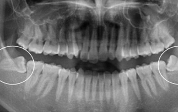 An X-Ray image of wisdom tooth extraction