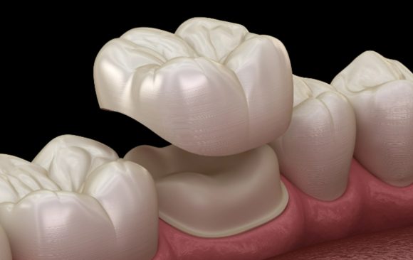 An image showing dental crowns