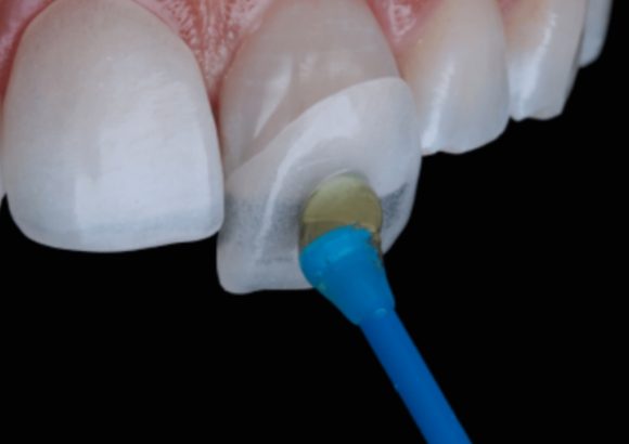 An image showing dental veneers