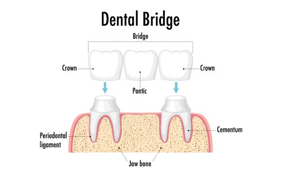 A vector image showing dental bridge