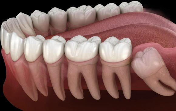 An image showing wisdom tooth extraction