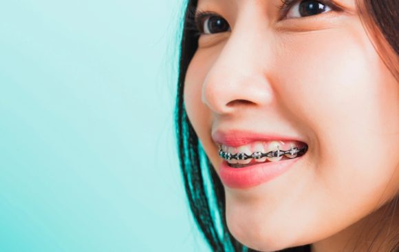 A woman similing with orthodontics teeth straightening