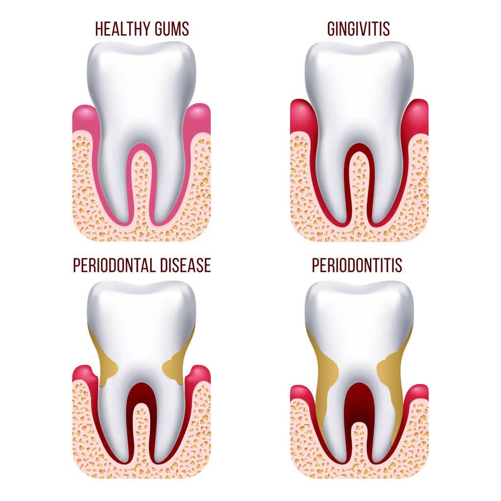 A vector image showing gum disease